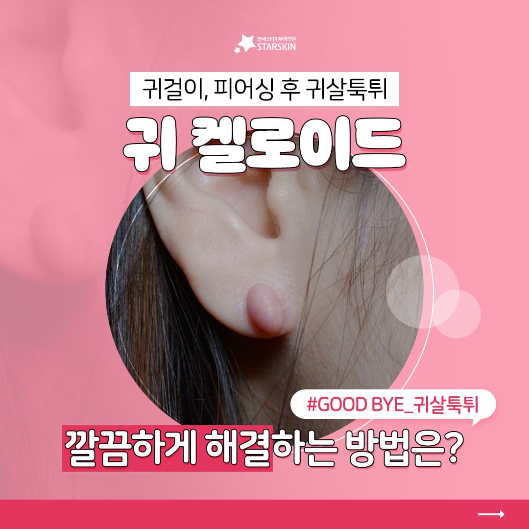 귀걸이, 피어싱 후 👂귀켈로이드! 🙊