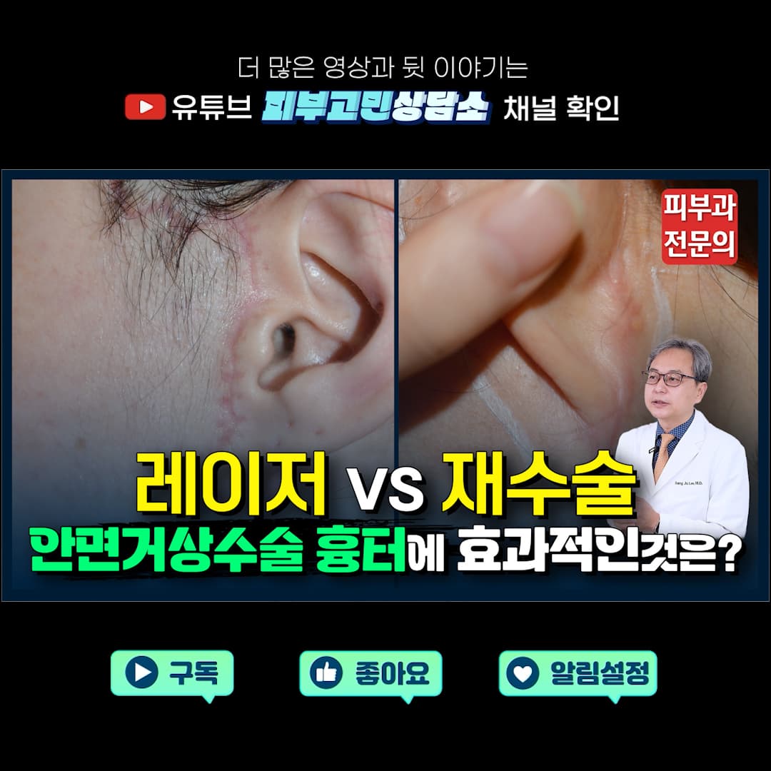 안면거상 수술 흉터 레이저 VS 재수술 뭐가 더 효과적일까?