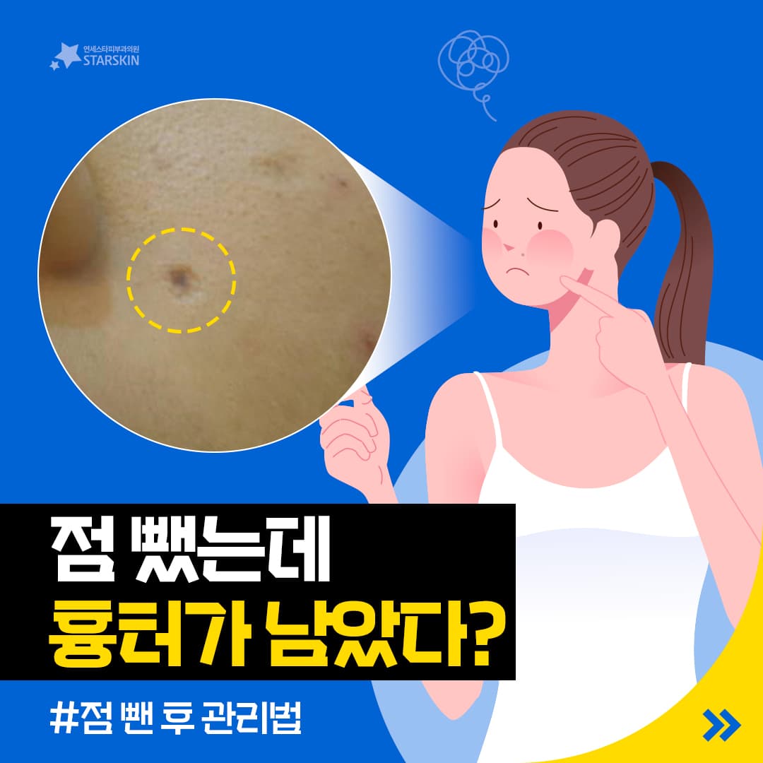 ์ ๋บ๋๋ฐ๐ตโ๐ซ ํํฐ๊ฐ ๋จ์๋ค?