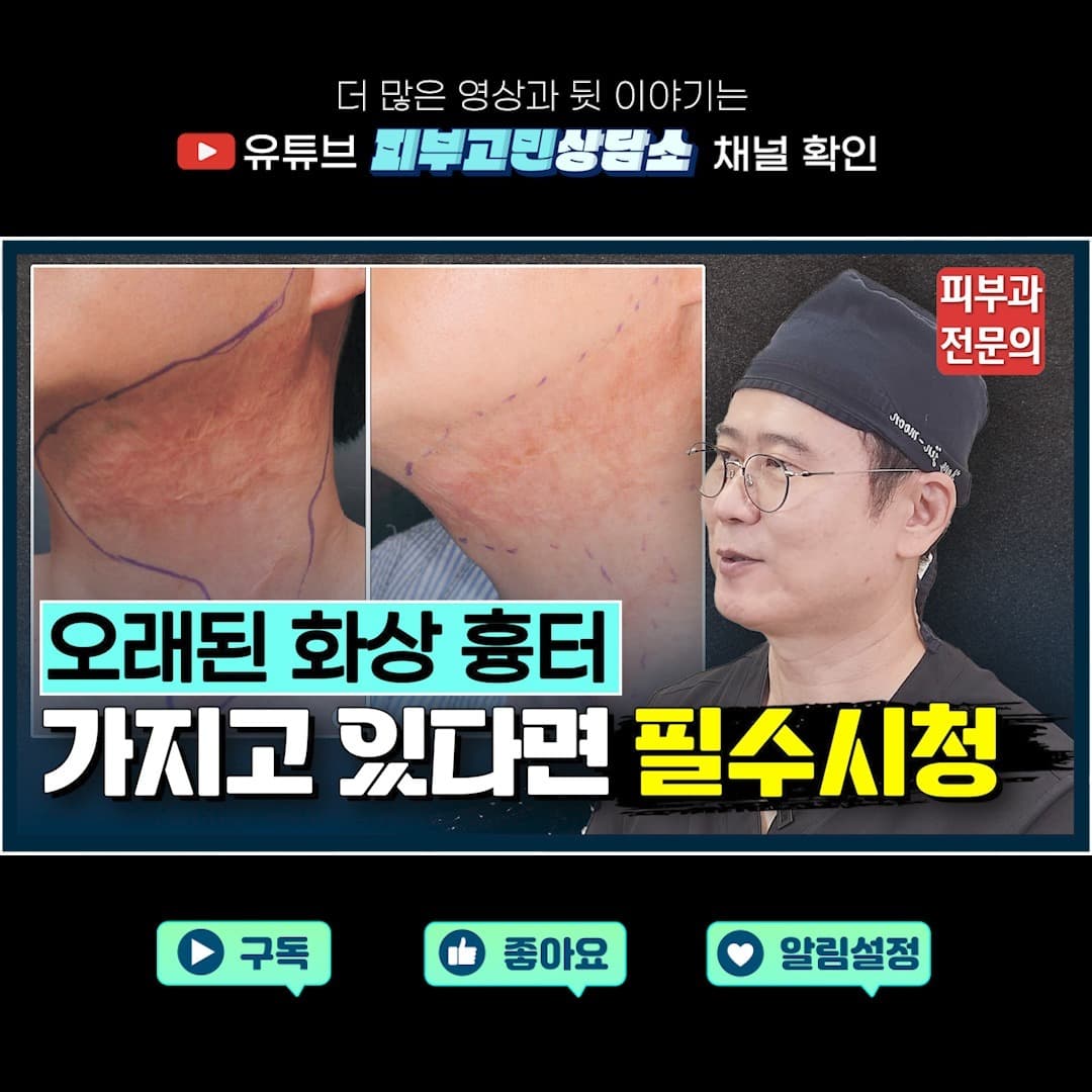 오래된 화상흉터 레이저 치료로🤷♀️없앨 수 있을까?