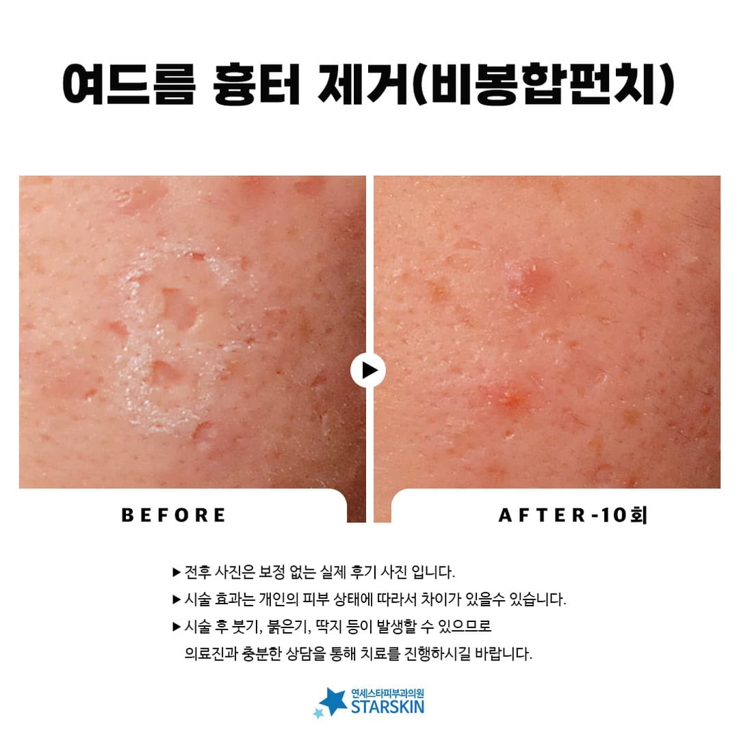 📸 Acne Scar Removal Before & After Photos (2023.09.20)