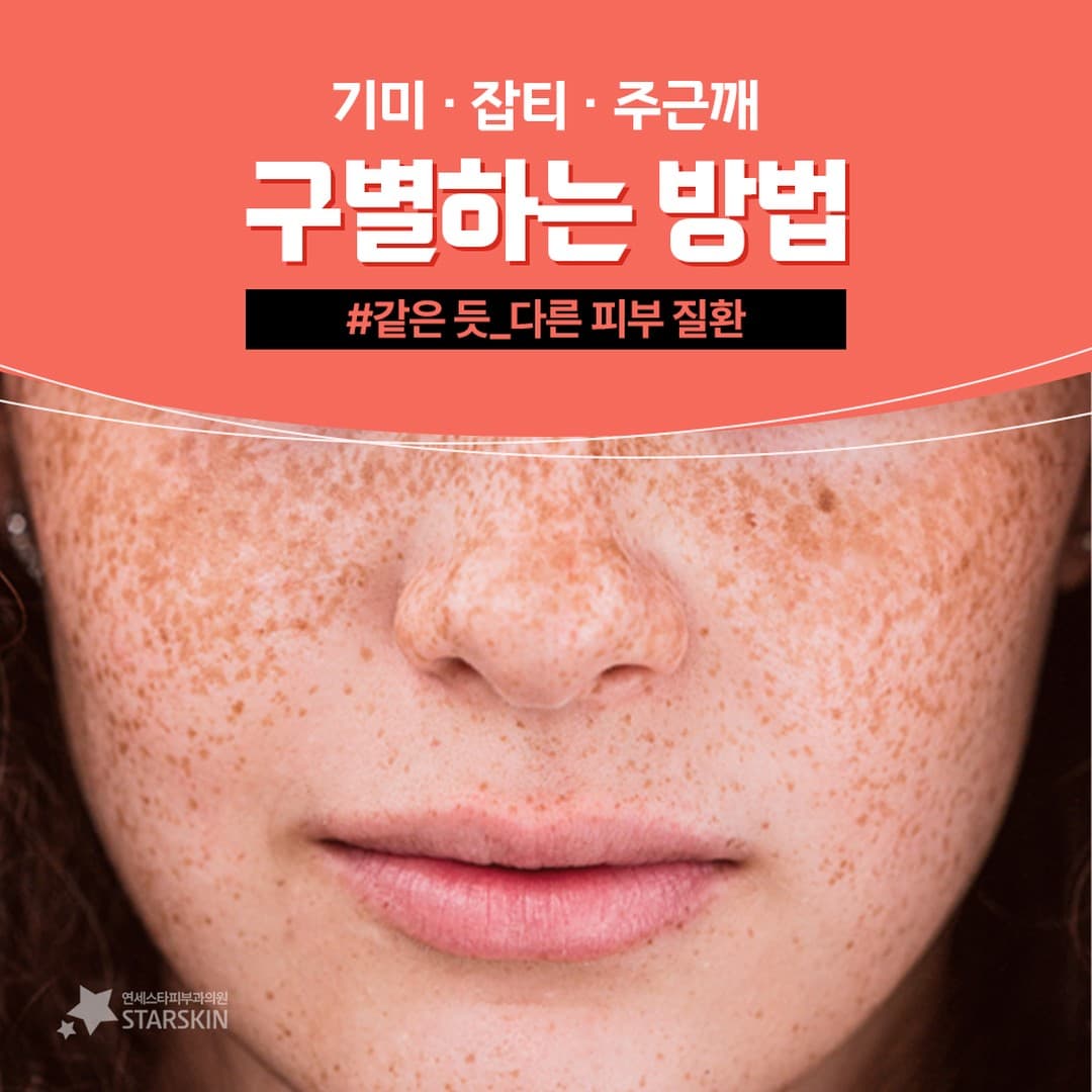 기미, 잡티, 주근깨 구별하는 방법!🧐