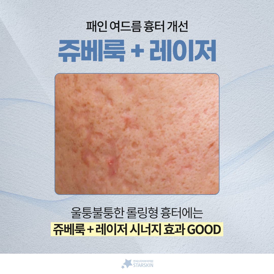 패인 여드름 흉터 개선에 탁월한 쥬베룩