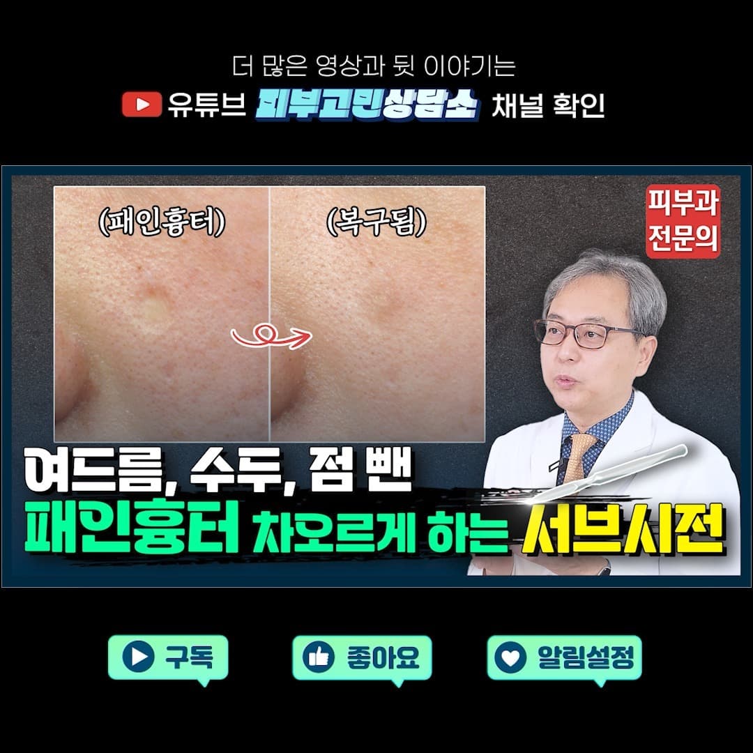 패인 흉터 레이저 치료했는데 효과 없다면? '서브시전' 시술의 모든 것