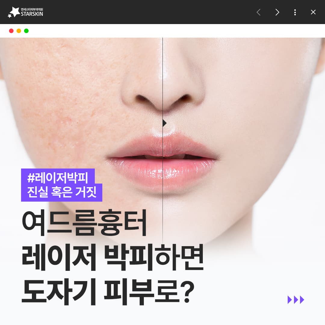 심한 여드름흉터 레이저 박피 하면 도자기 피부로?