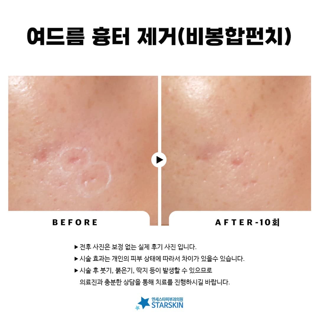 📸 Before & After Photos of Acne Scar Removal (2023.10.18)