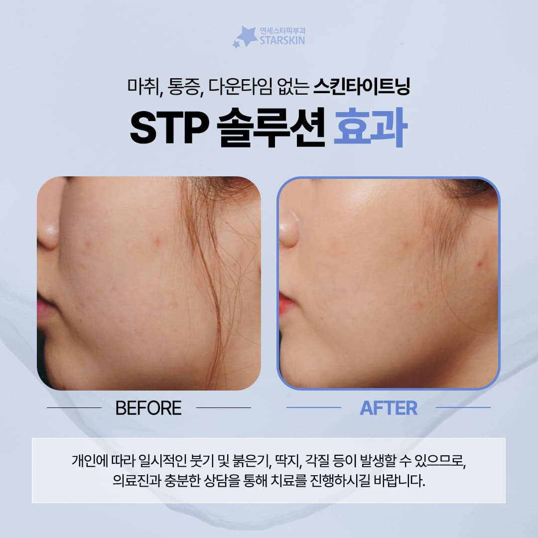통증걱정없는🙅 탄력 리프팅 STP솔루션 (2023.11.22 #2)