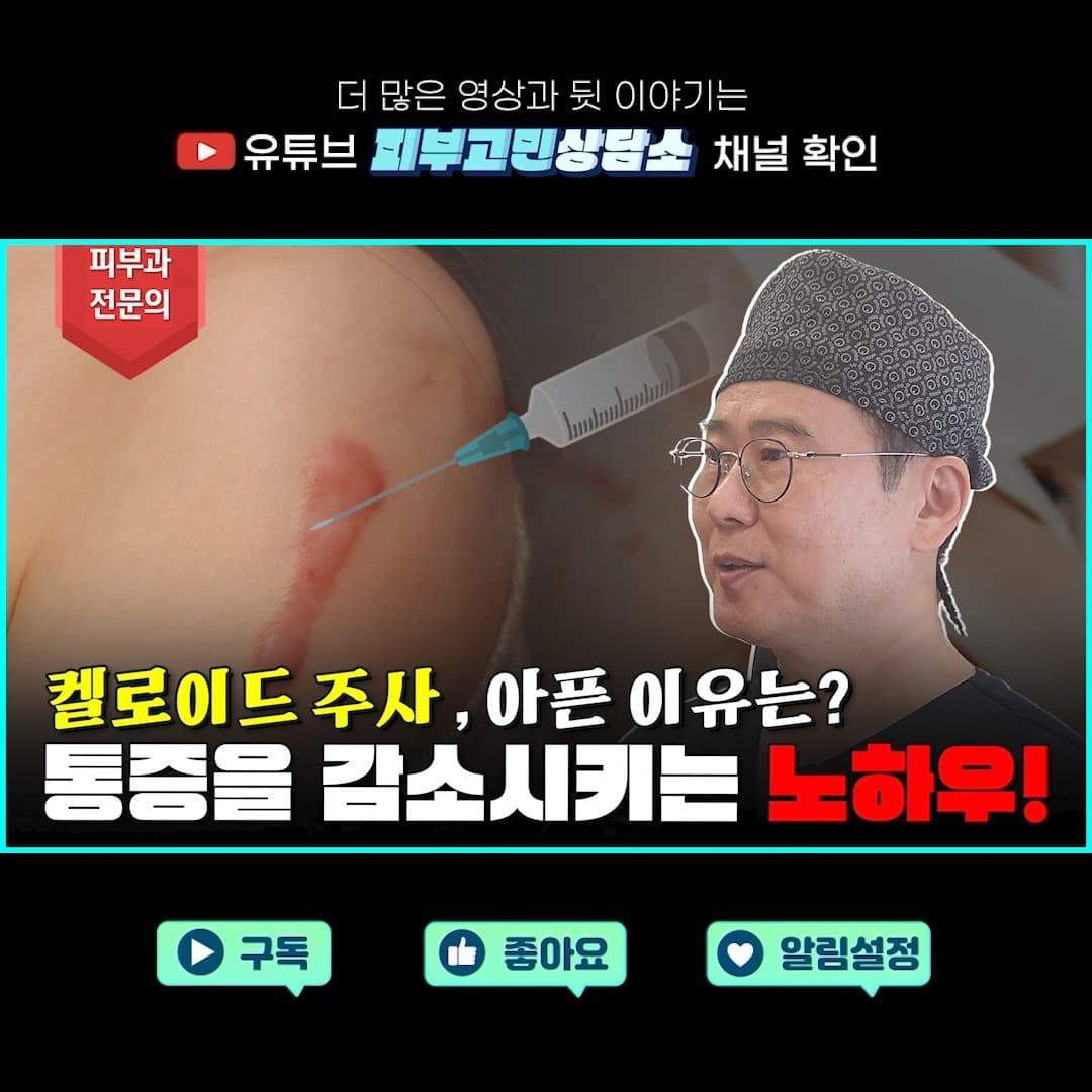 While receiving keloid treatment