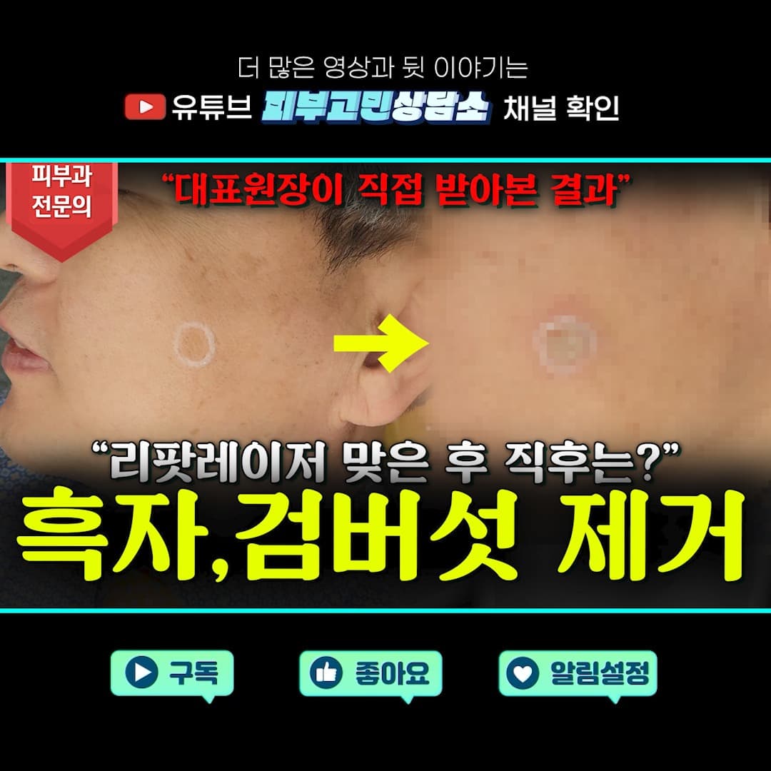 안녕하세요! 오늘은 제가 직접 리팟레이저 시술을 받은 후기를 솔직하게 나눠보려고 합니다. 과연 의사도 만족할 만큼 효과가 있었는지, 어떤 점이 좋았고 불편했는지 하나하나 자세히 알려드릴게요.