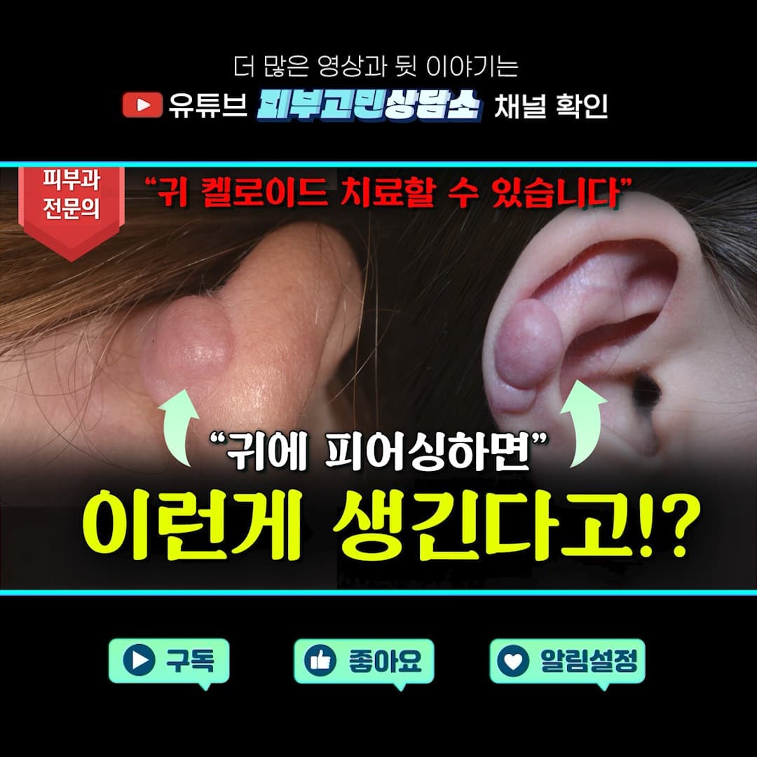 귀 켈로이드, 그냥 두면 (2025.02.13)