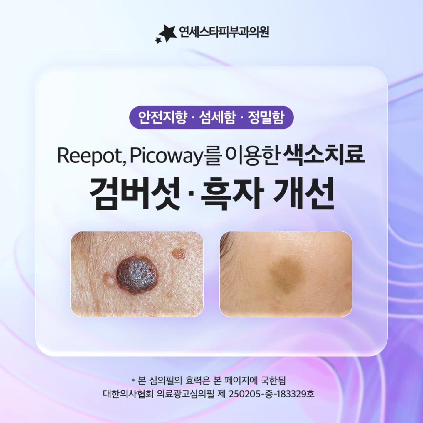 점점 짙어지는 흑자, 검버섯 치료