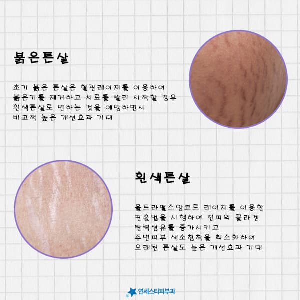 古い肉割れ、ピンホール法は効果があるのか?