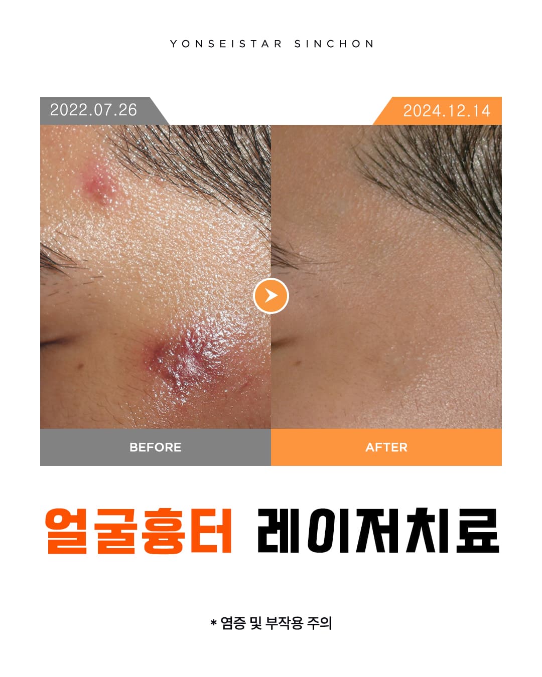 눈에 잘 띄는 얼굴흉터 😨 (2025.04.29)