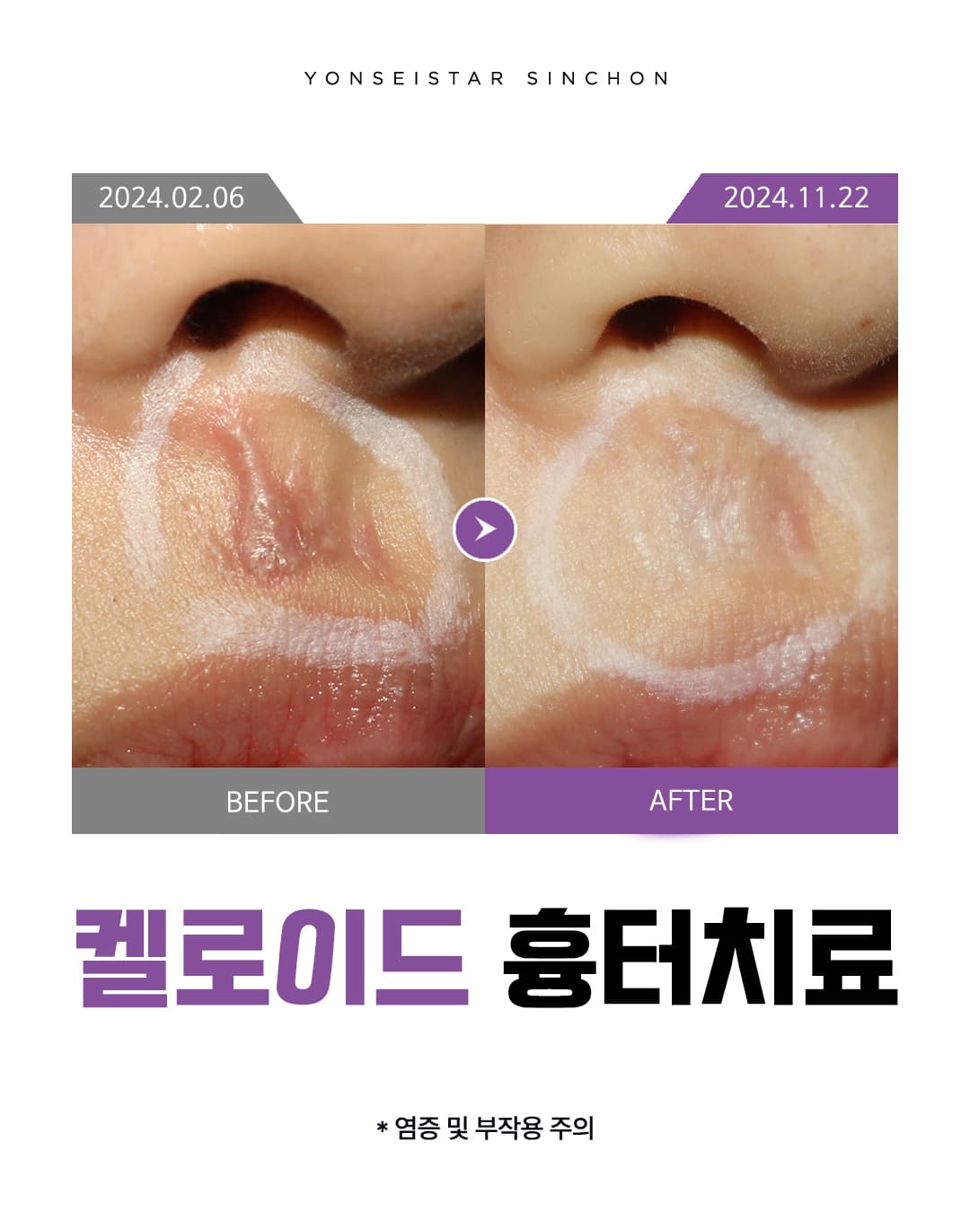 다양한 이유로 생기는 켈로이드 흉터 (2025.05.08)