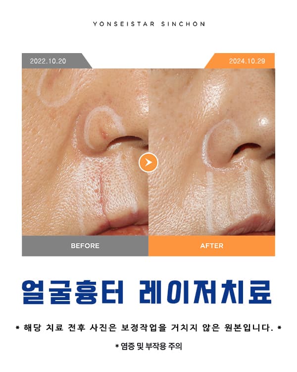 Impression and image due to facial scars (2025.05.23)
