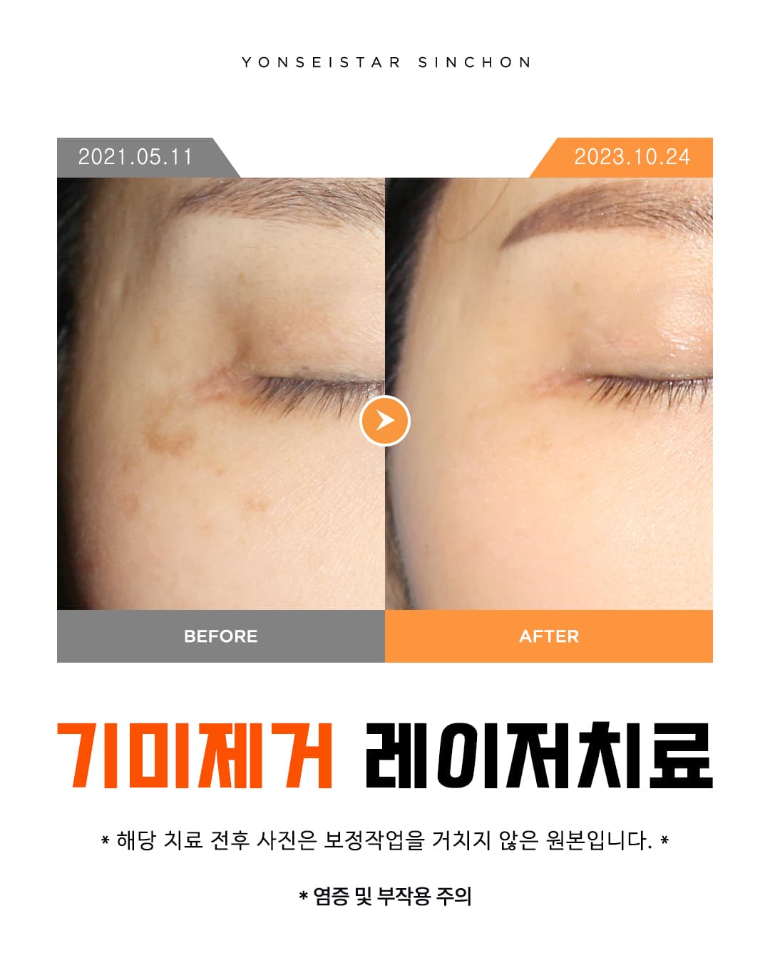 한 번 생긴 기미자국은 (2025.05.23)