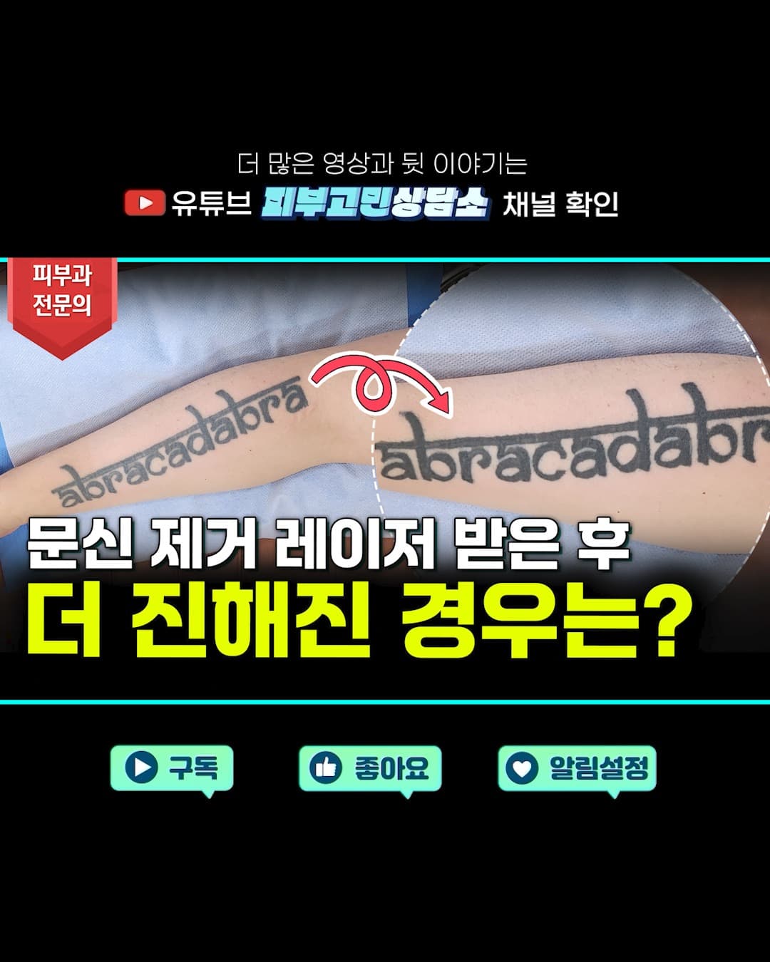 문신을 없애려고 레이저 시술을 받았는데, 오히려 더 진해졌다구요?