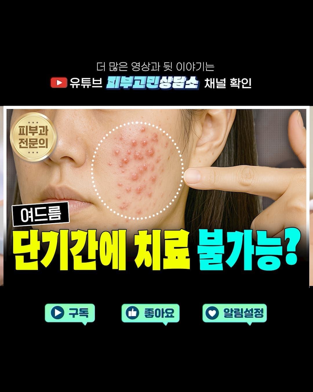 단 하루 만에 여드름이 사라진다?