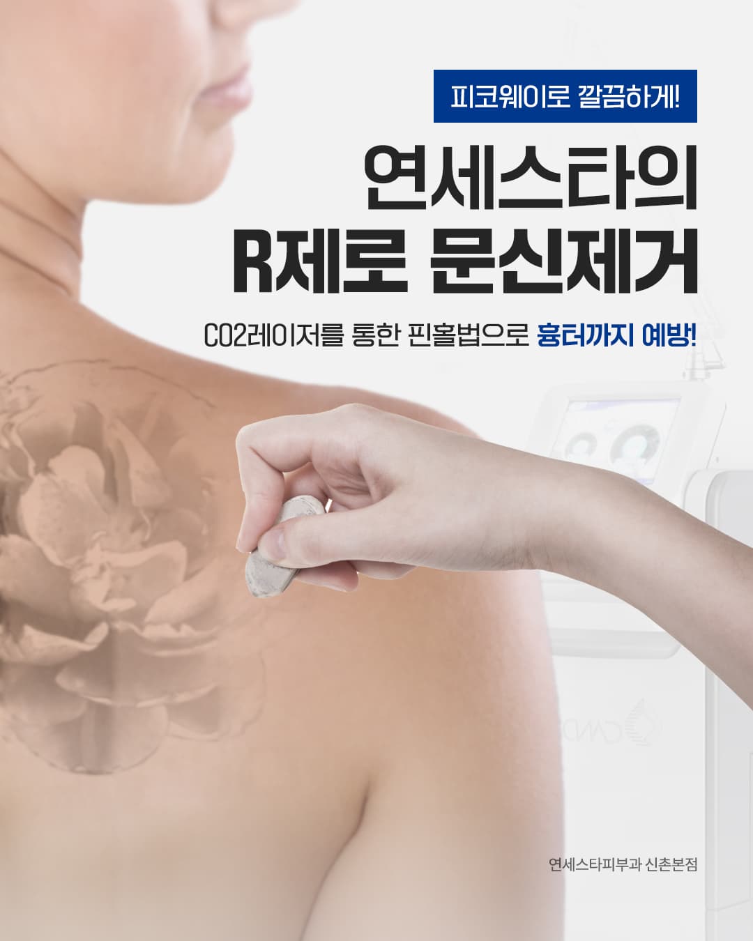문신제거, 흉터가 걱정된다면?