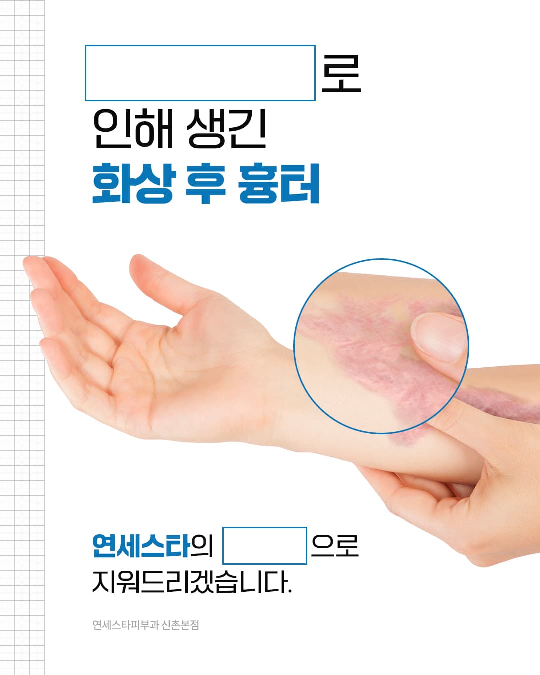 Burn scars often damage