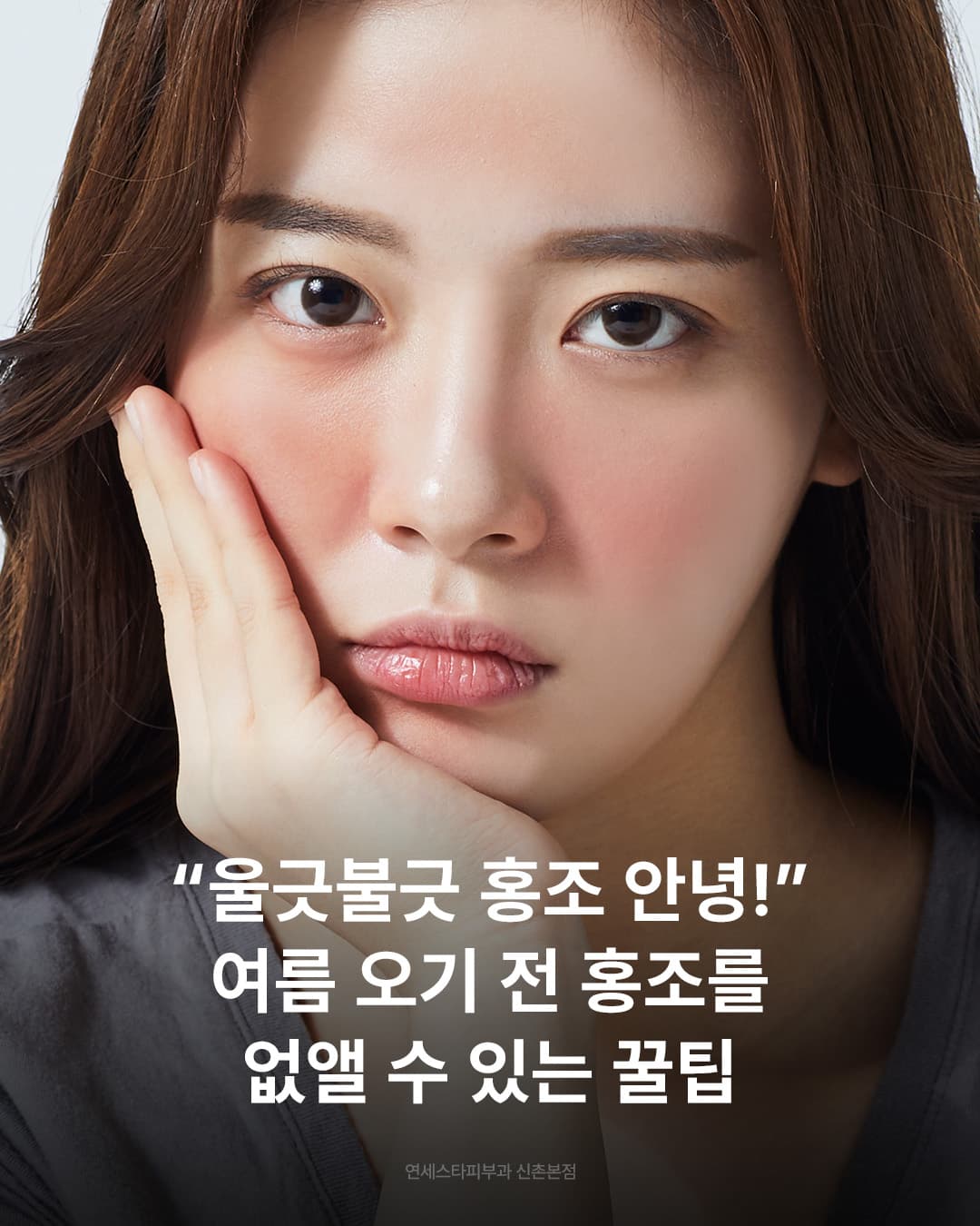 안면홍조가 자주 올라오는 요즘,