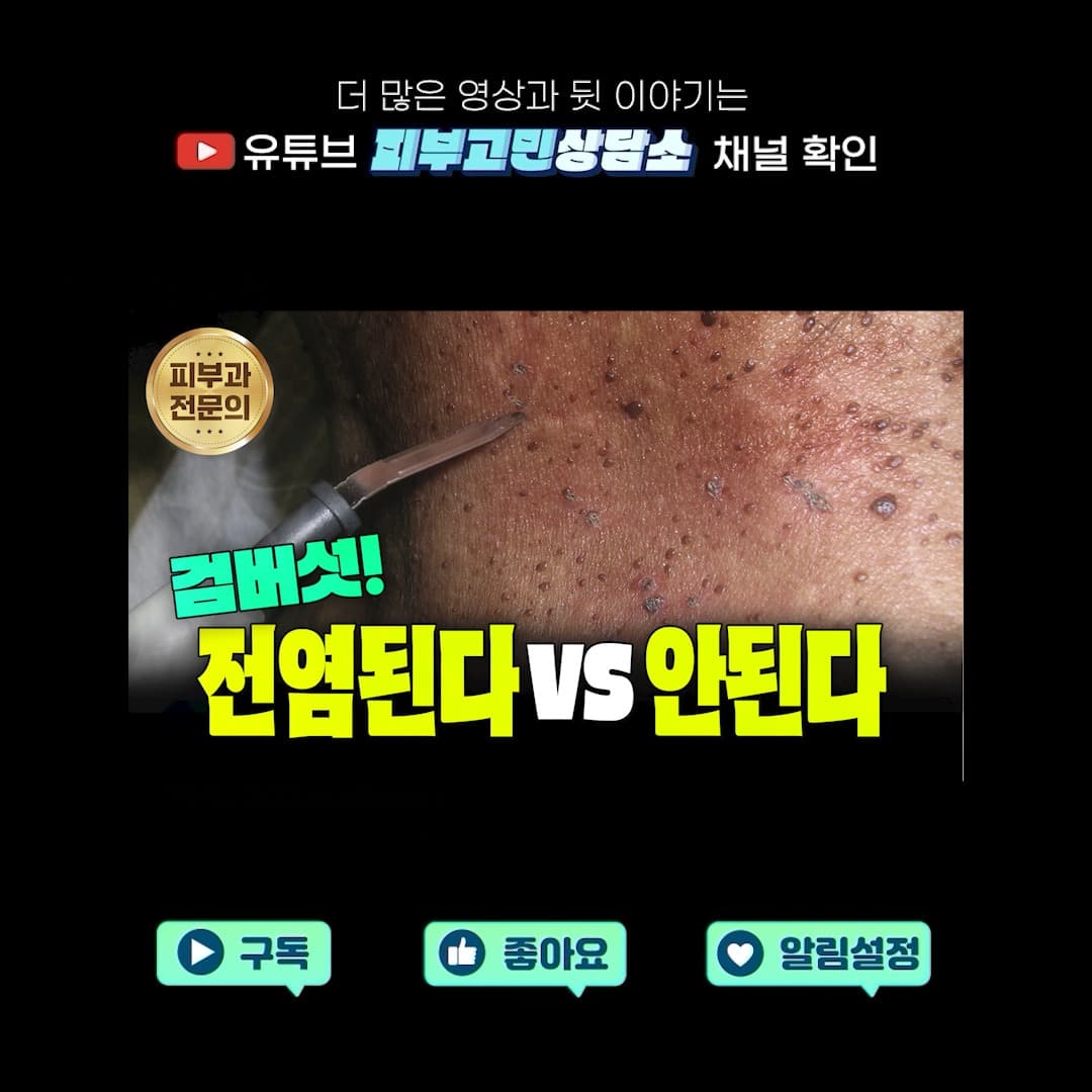Brown spots on the skin of the elderly, age spots.