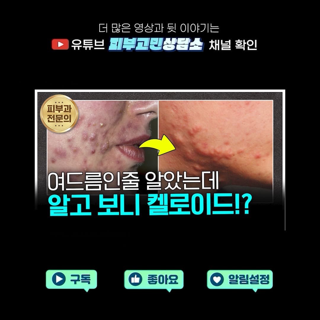 겉으로는 여드름처럼 보였지만,