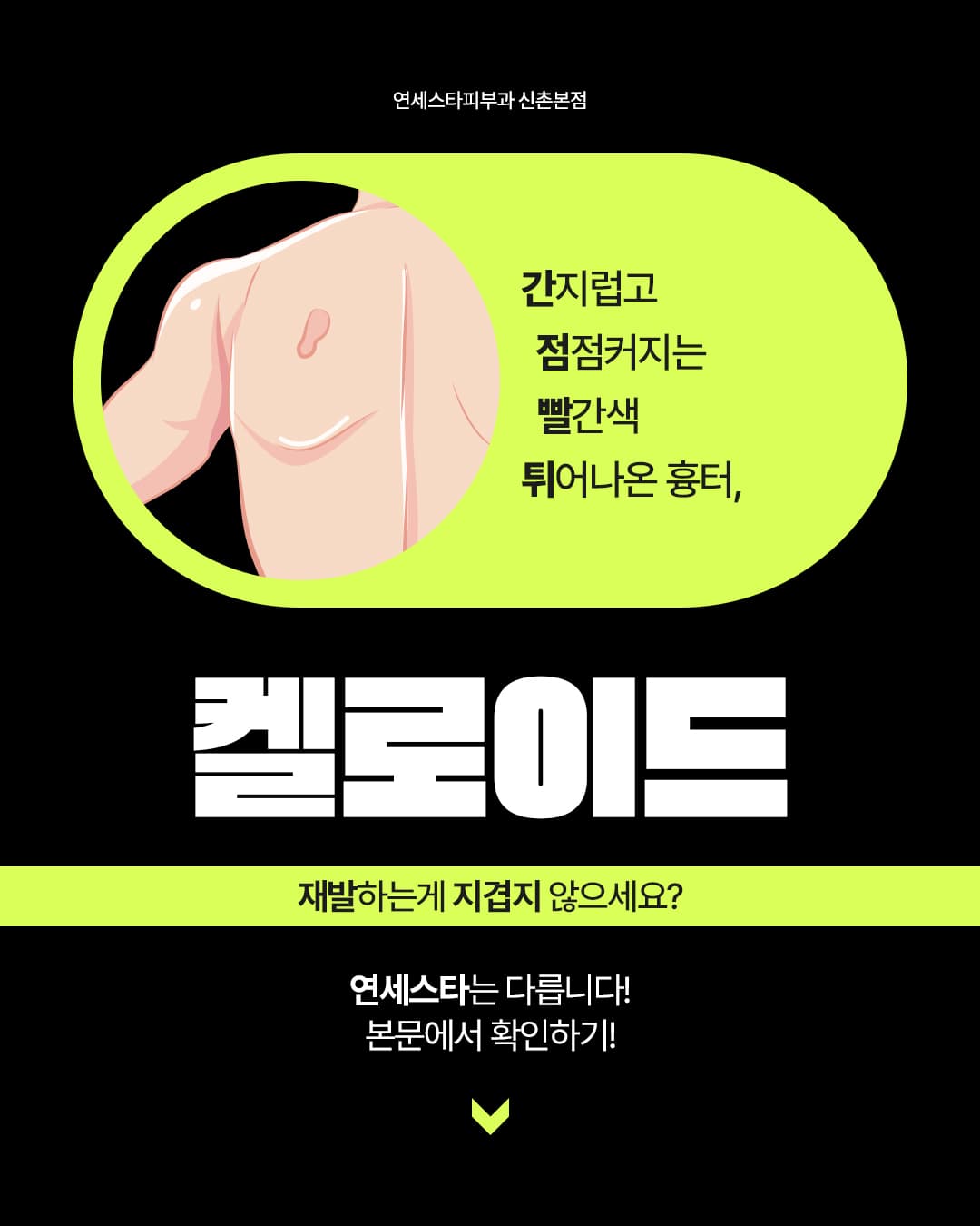 ✔ 켈로이드 특성에 따라