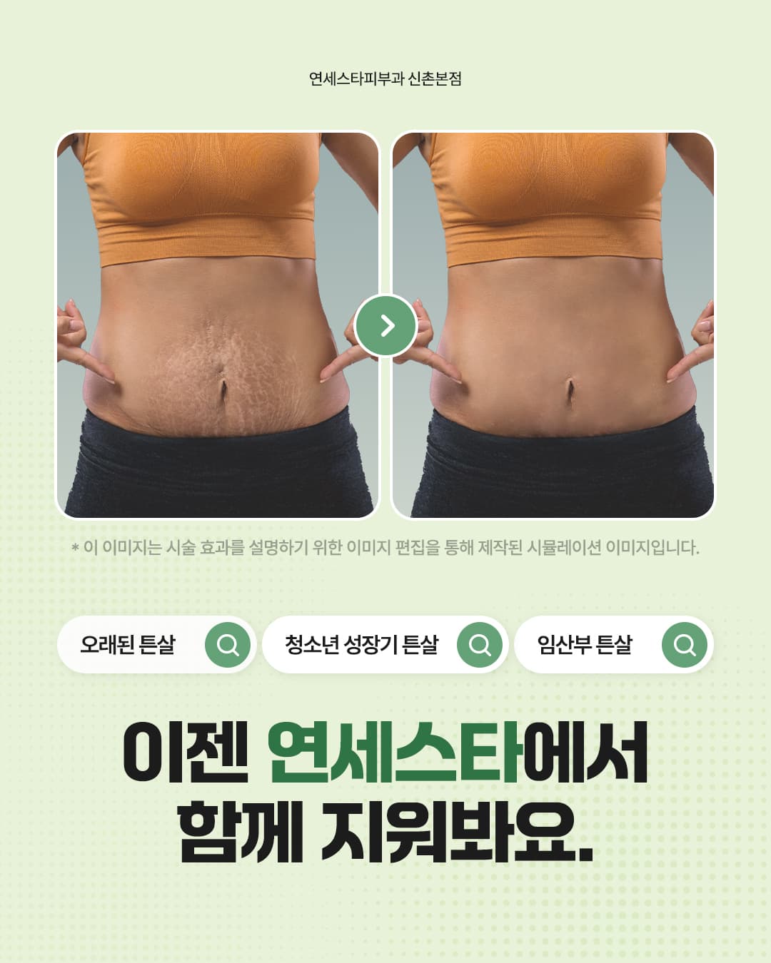지워지지 않던 튼살,