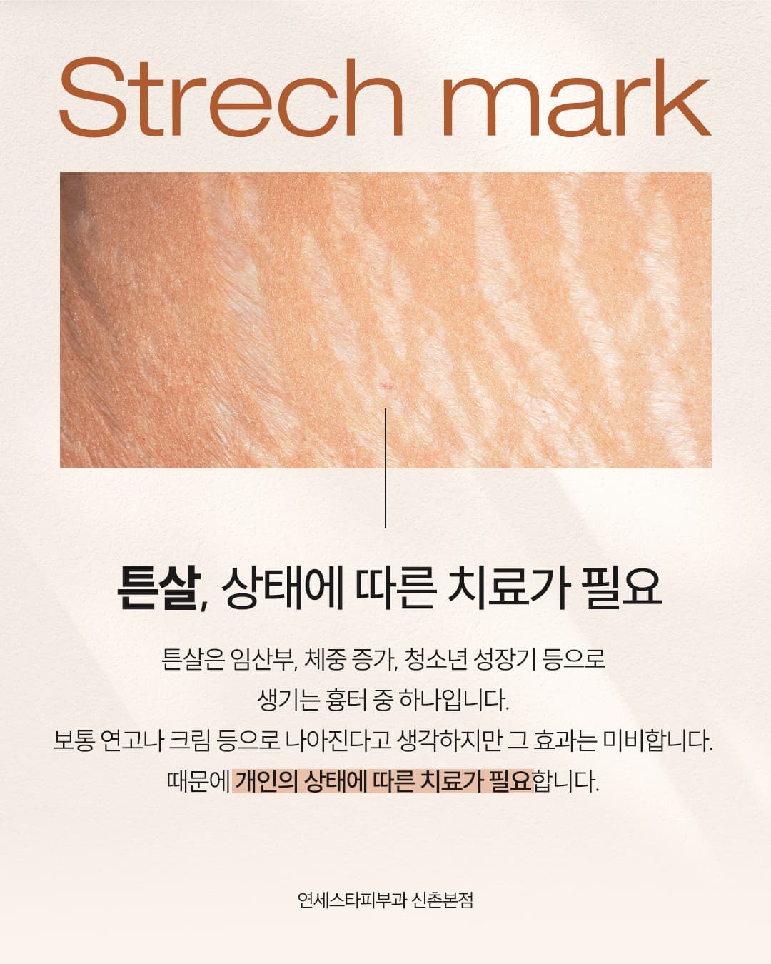 📌 Do stretch marks disappear over time?