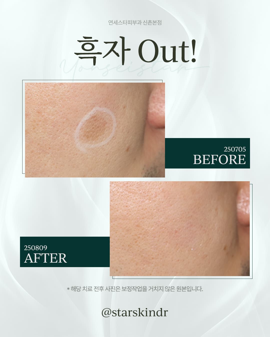 자꾸 진해지는 흑자, 방치하지 마세요!