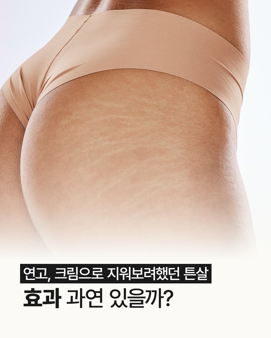 ✨ 튼살, 크림만으로는 한계!