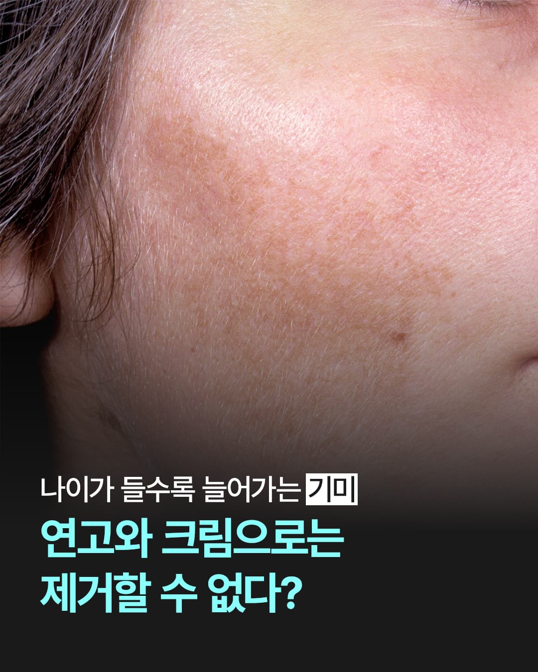 Melasma doesn't disappear with just ointments or creams. (2025.10.15)