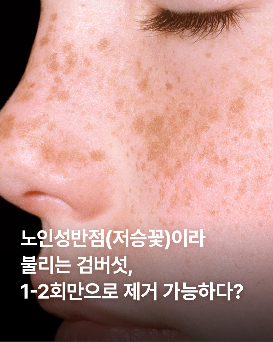 🌞 Age spots caused by aging and UV rays,