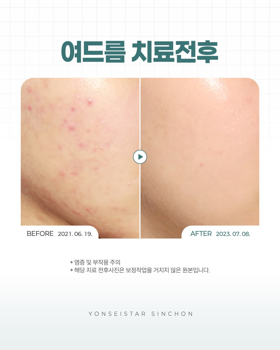 Tiresome Acne Problems,