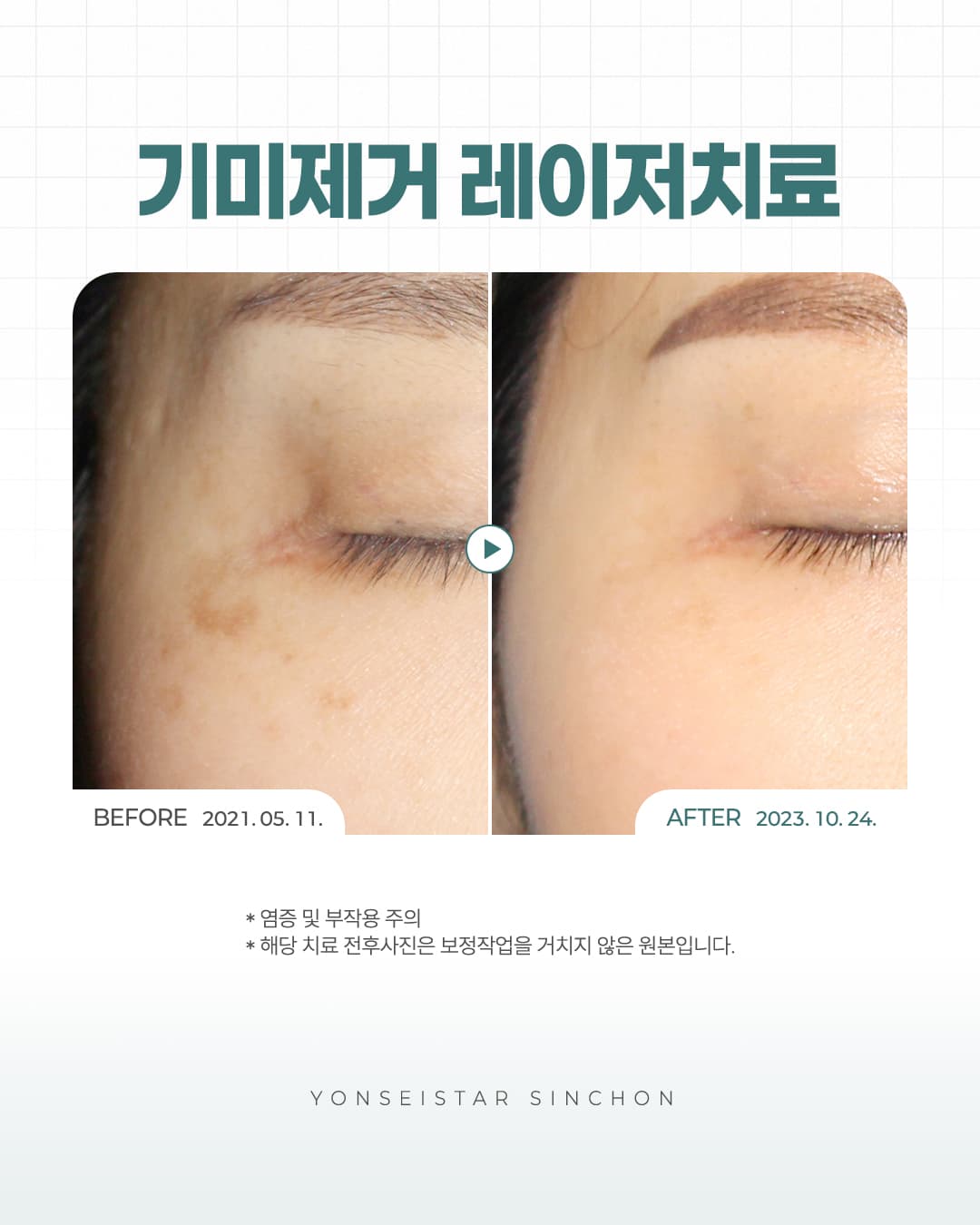 한 번 생긴 기미자국은