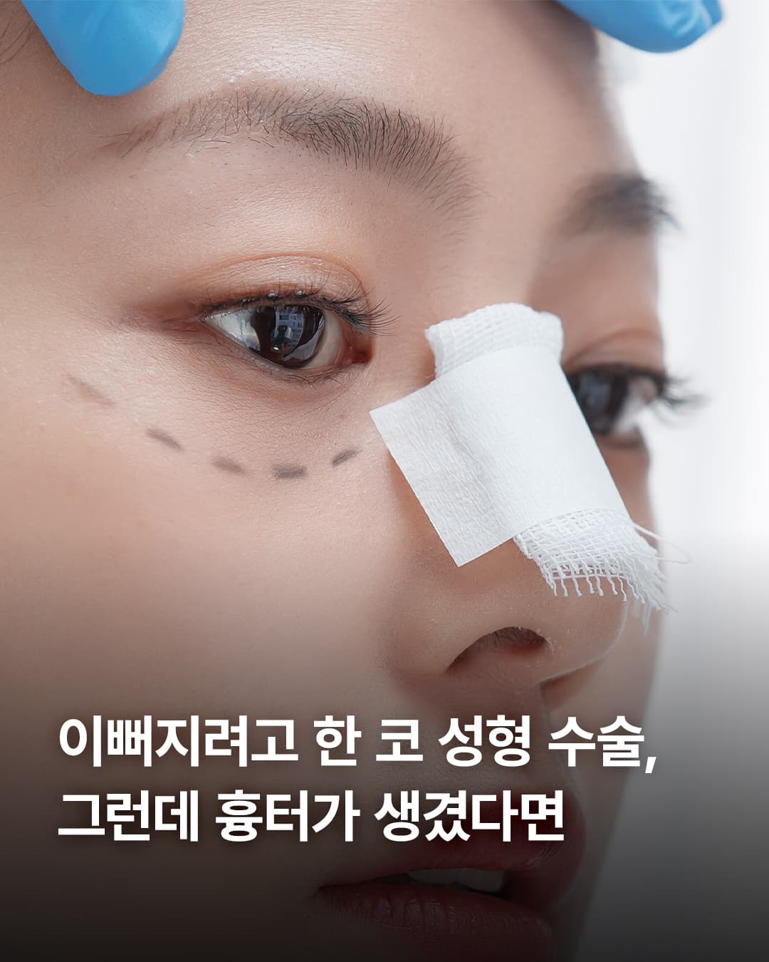 비주 성형 후 생길 수 있는 비주훙터,