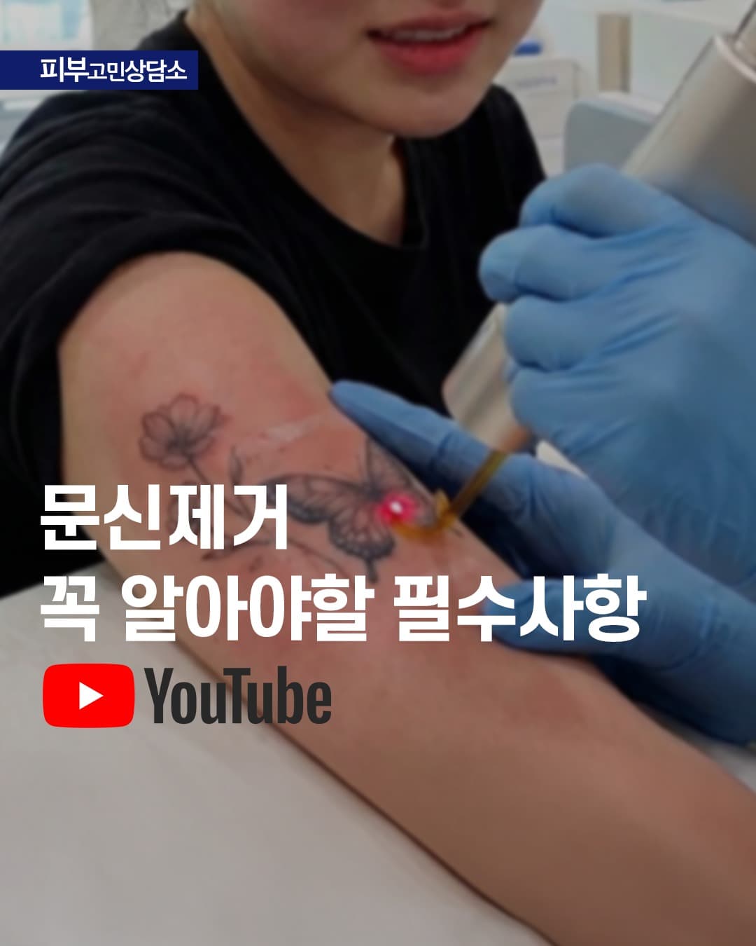 문신제거, 결과의 차이를 만드는 3가지 비법