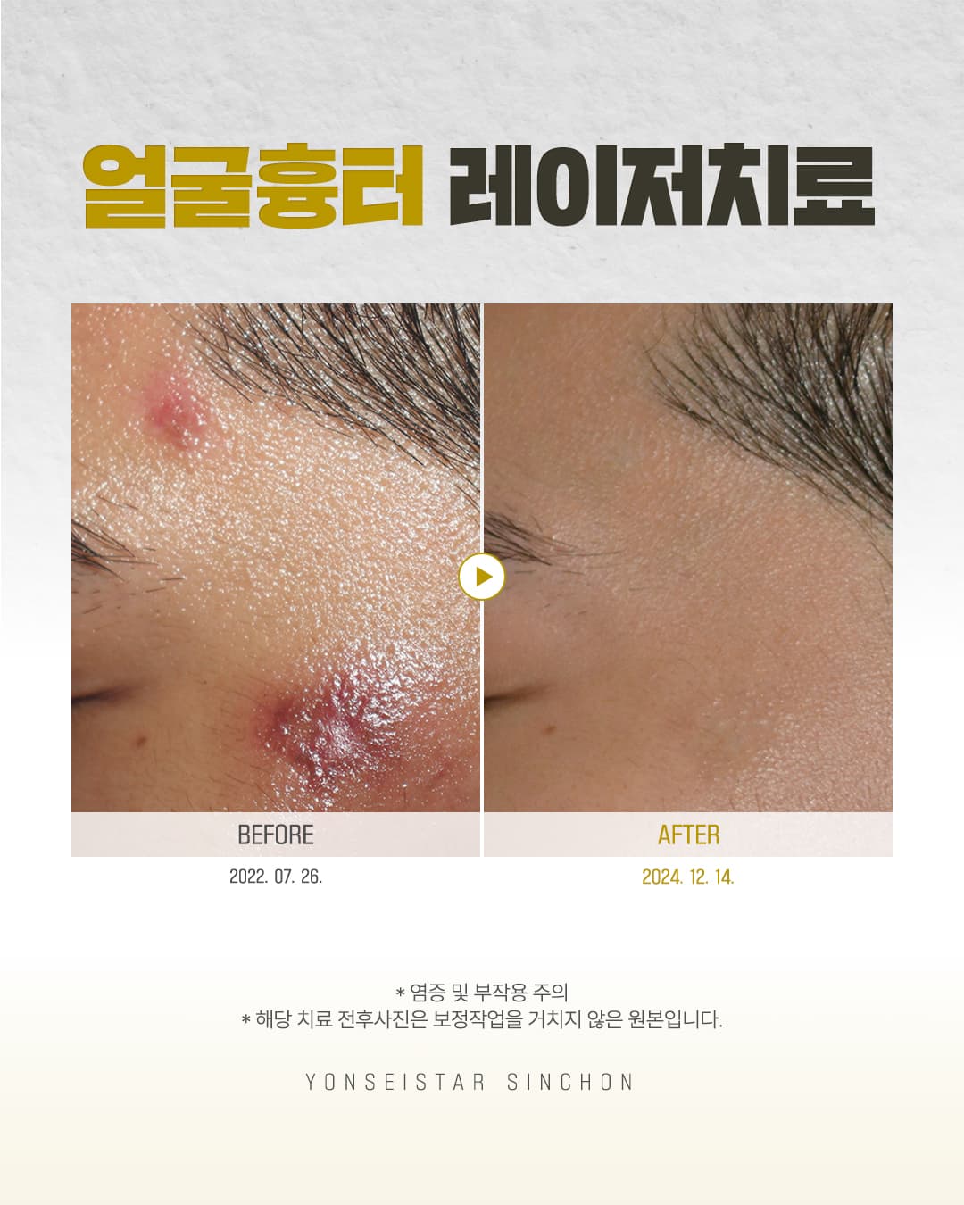눈에 잘 띄는 얼굴흉터 😨