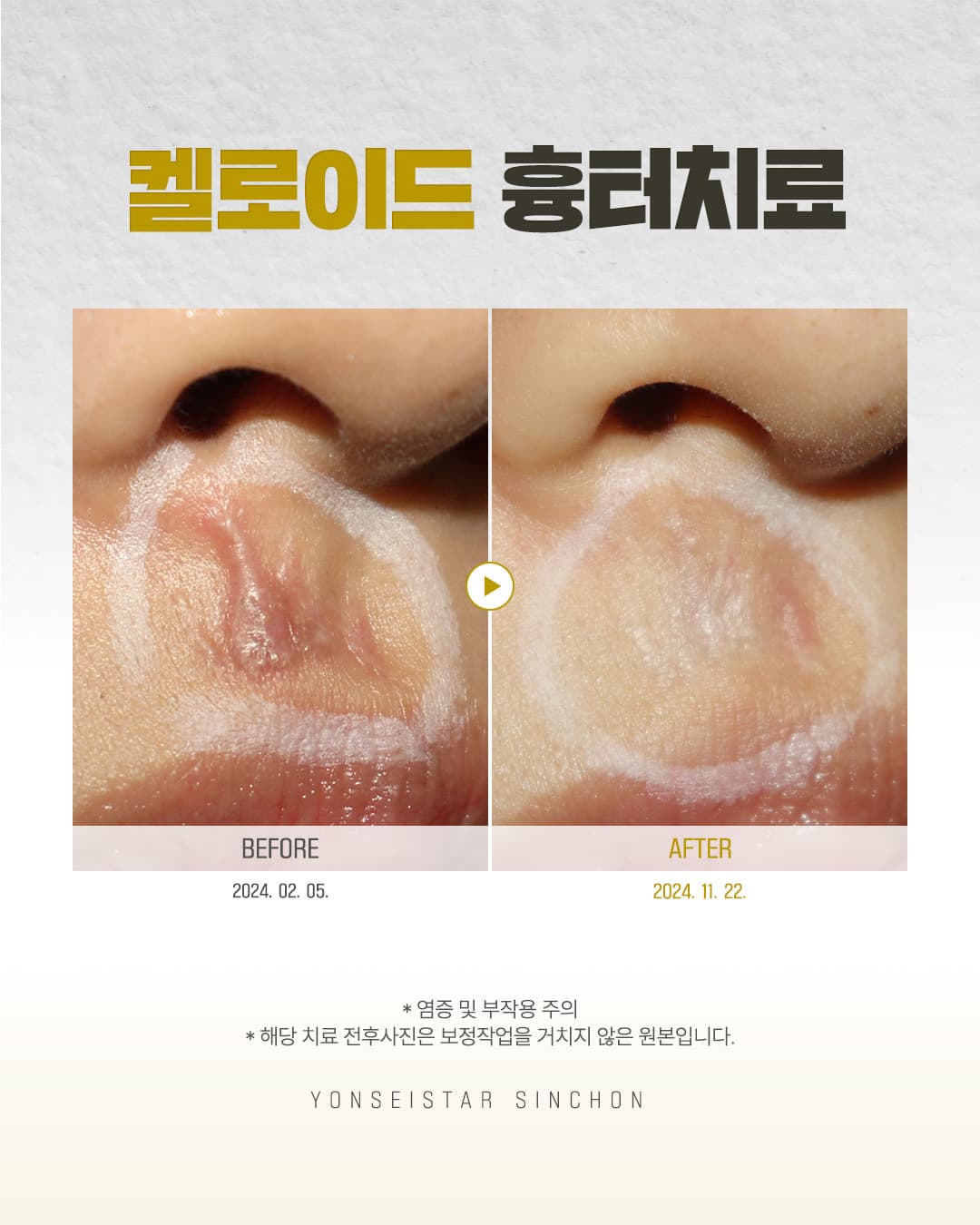 Keloid Scars
