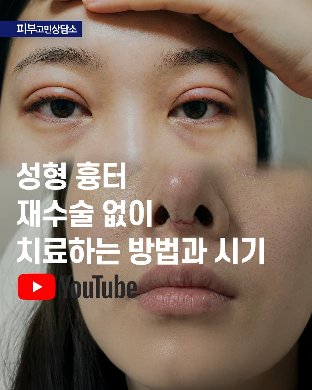 整形手术疤痕