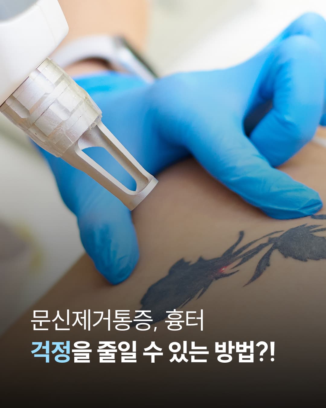 刺青除去