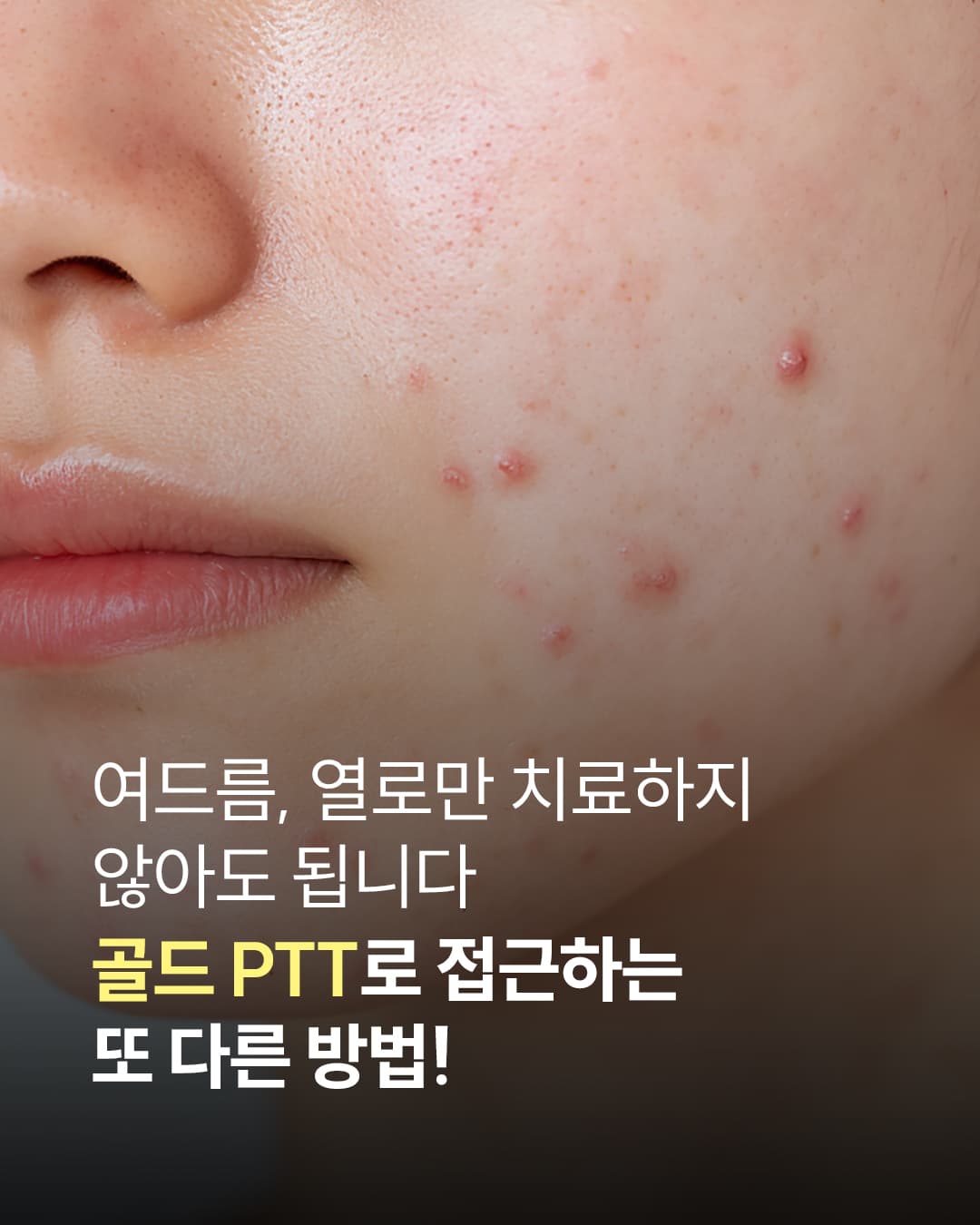 Acne Treatment