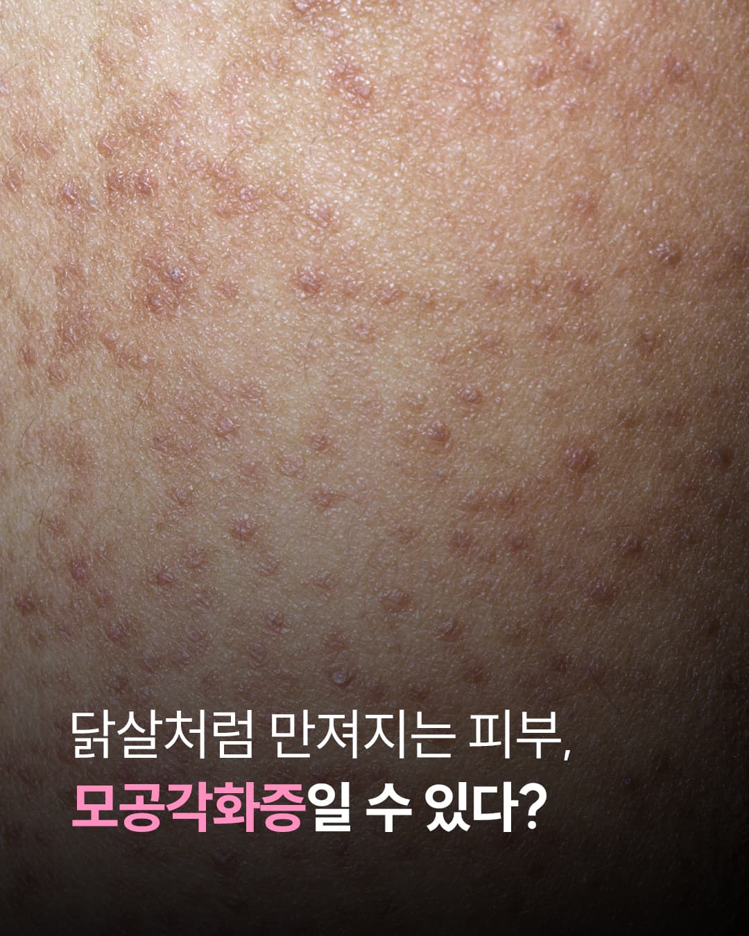 Keratosis Pilaris (Chicken Skin)