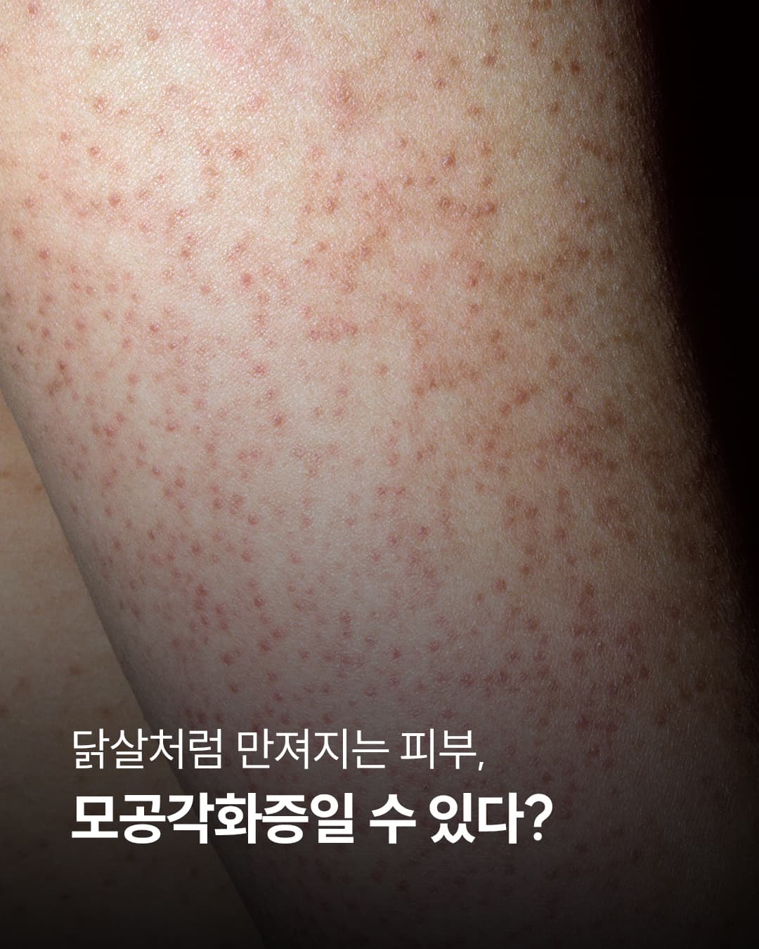 毛孔性苔癬、