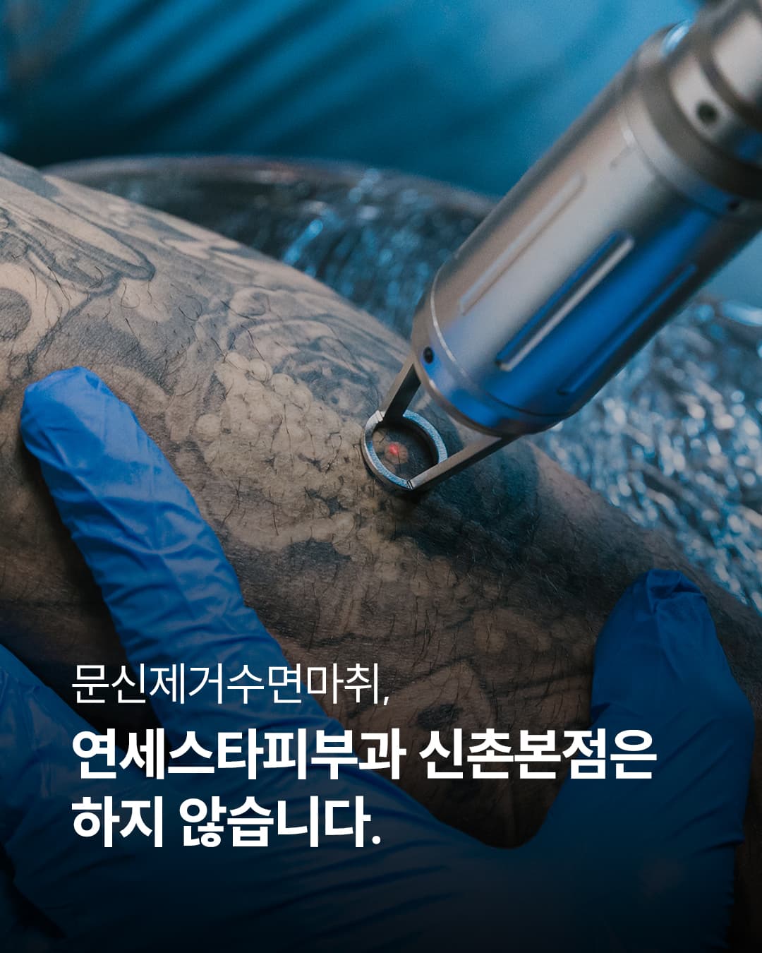 Tattoo removal, because of pain