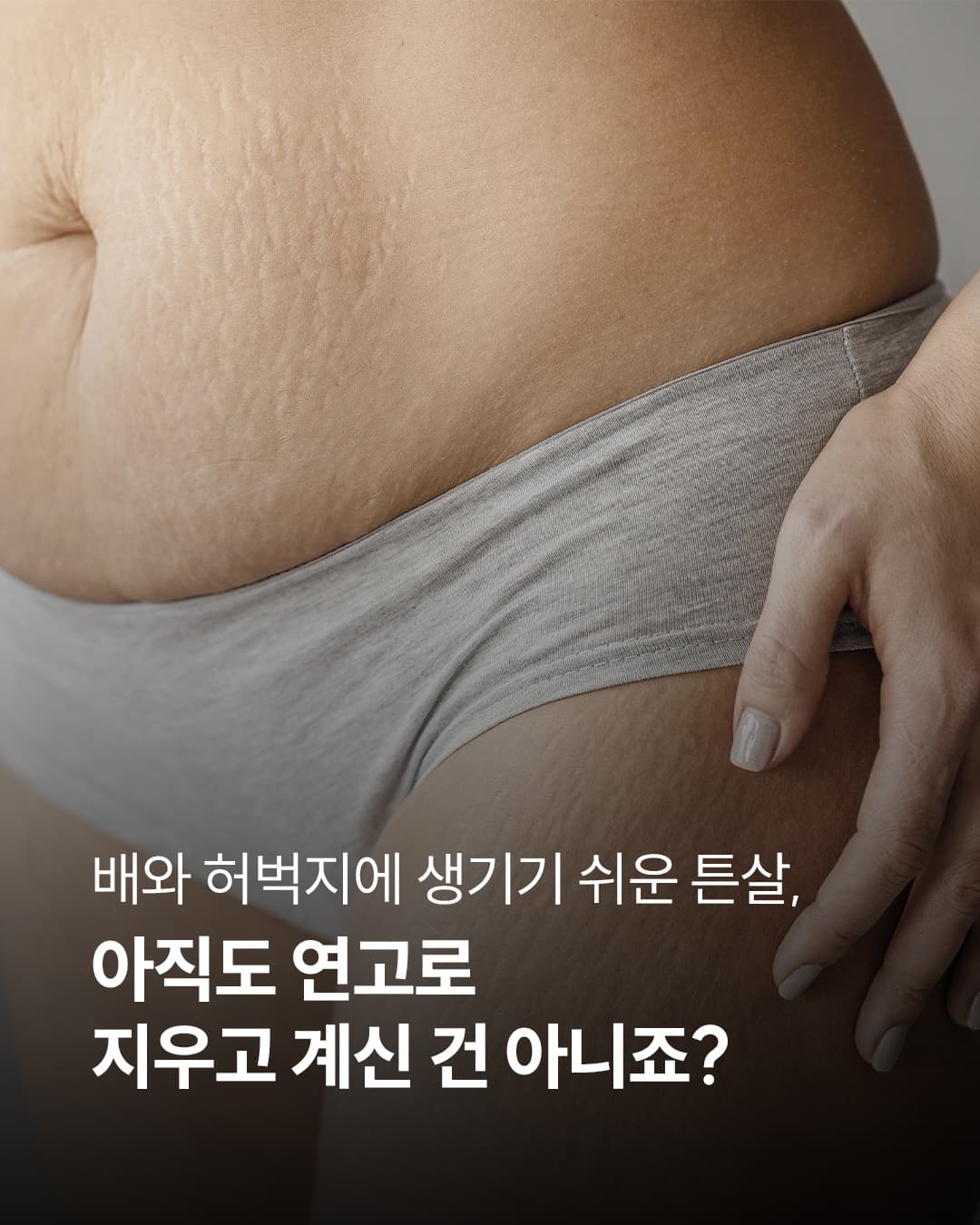 아직도 튼살에 연고만 바르고 계신가요?🧴