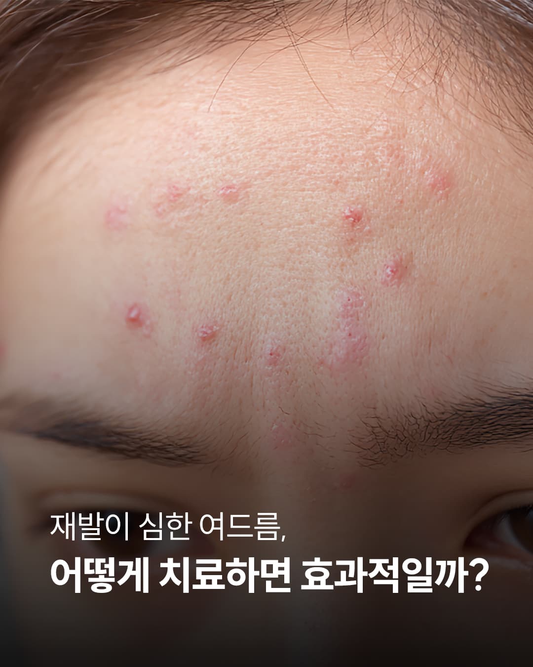 Tired of acne,