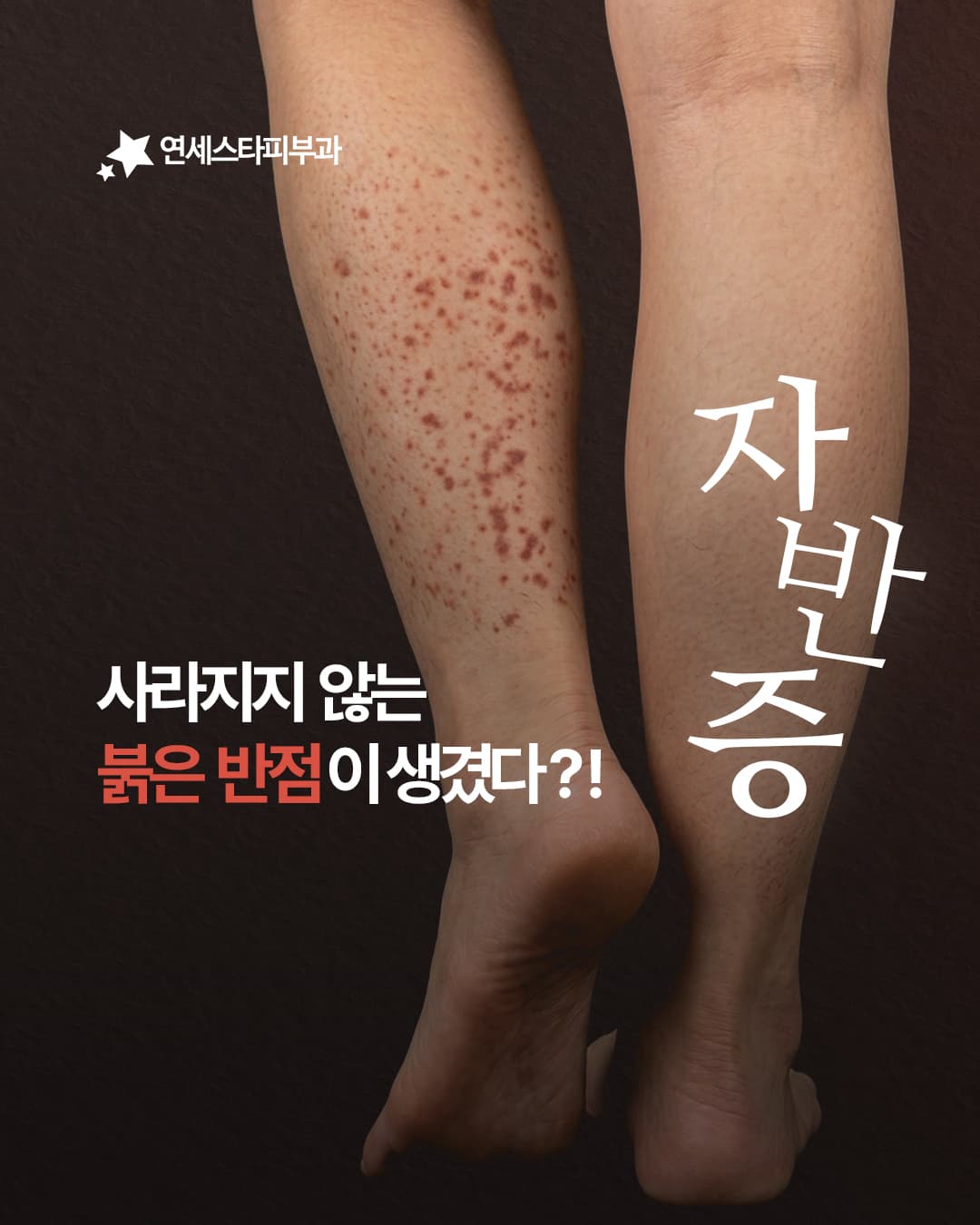 갑자기 붉은 반점이 생겼다면