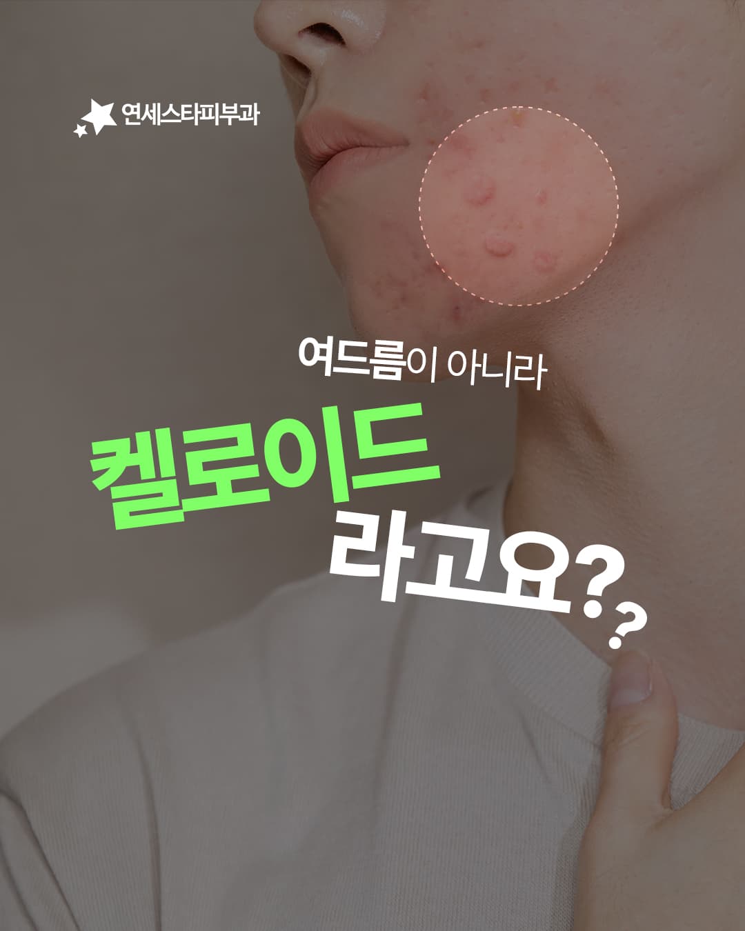 몇 달째 없어지지 않는 지긋지긋한 여드름,